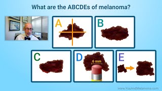 What are the signs and symptoms of melanoma [upl. by Pressey]