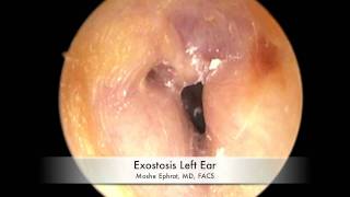 Ear Canal Exostoses [upl. by Grega]