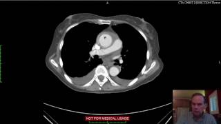 Aortic Mural Hematoma CT [upl. by Lleihsad]