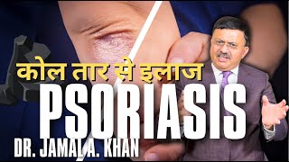 Psoriasis Causes Triggers and Treatments  Dr Jamal A Khan [upl. by Gregory]