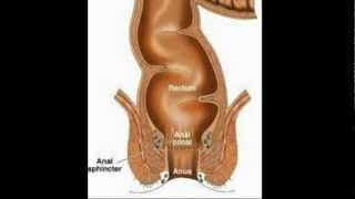 Rectal Cancer An Overview  Los Angeles Colonoscopy [upl. by Htrag]