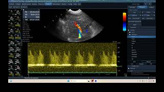 IQ 304 IVER DOPPLER ULTRASOUND ECHOPAC ANALYSIS 3 [upl. by Legra]