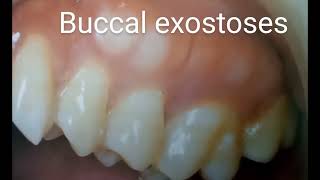 Buccal exostoses [upl. by Euqinomod]