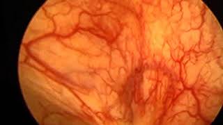 Endoscopic view of interstitial cystitis bladder during low pressure cystoscopy [upl. by Erlina]