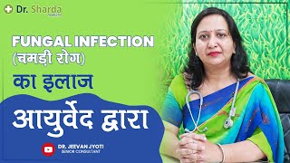 Ayurvedic Treatment for Fungal Infection  Cure Skin Disease with Ayurveda  Dr Sharda Ayurveda [upl. by Ecirtnahc]