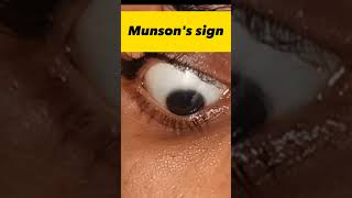 Rizzuti sign and Munsons sign seen in keratoconus eyes clinical opthalmology optometrists [upl. by Anastas]