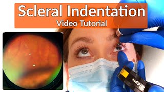 Scleral Indentation  Depression Tutorial [upl. by Robers975]