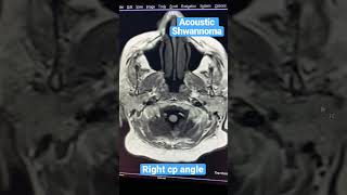 Acoustic Shwannoma Brain [upl. by Oralee]