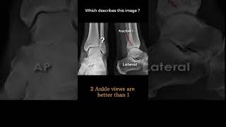 2 Ankle views are better than 1 10 Musculoskeletal Xray Viewing principles radiologychannel007 [upl. by Ahsi]