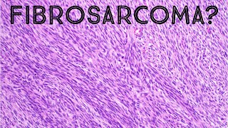 Fibrosarcoma amp Herringbone Pattern Explained in 5 Minutes pathology sarcoma dermpath [upl. by Nedda850]