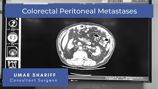 Colorectal Peritoneal Metastases CPM Key facts [upl. by Gothart]