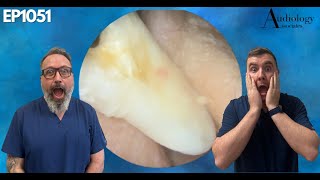 The Massive Plug of Skin Removed From an Ear  EP1051 [upl. by Benedick]