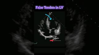 False Tendon in Left Ventricle echocardiography heartdisease heart [upl. by Ayirp]