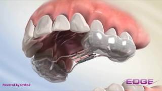 Rapid Palatal Expander RPE [upl. by Ase406]