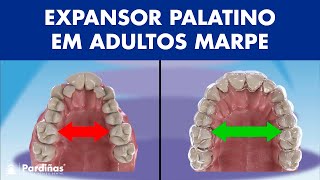 MARPE ORTODONTIA  Assim funciona o aparelho no ceu da boca em adultos © [upl. by Ryle]