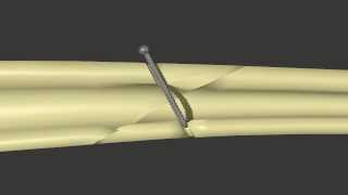 Fracture Fixation Lag Screw [upl. by Wendolyn]