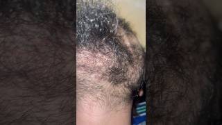 Beard hair removal removingingrown hairissue satisfying ingrownhairremoval hair ingrown [upl. by Araldo158]