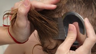 How to get rid of nits [upl. by Noruq]