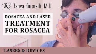 Rosacea and laser treatment for rosacea [upl. by Sisson]