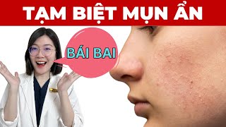 trị MỤN ẨN dưới da tại nhà hiệu quả  đơn giản  Thạc sĩ  Bác sĩ Phương Quý [upl. by Brathwaite]