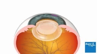 How cataract surgery is carried out  Bupa Health [upl. by Enahs]