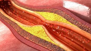 Arteriosclerosis Atherosclerosis explained in Malayalam [upl. by Chu]