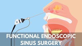 What is a Functional Endoscopic Sinus Surgery [upl. by Kirst]