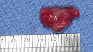 Marsupialization  Decompression of Odontogenic Cysts Part 2 [upl. by Evette]