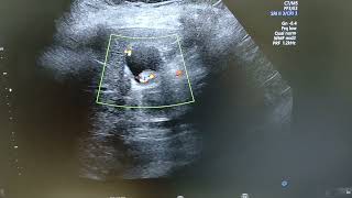 Adenomyomatosis  Comet tail artifacts  Choleithiasis [upl. by Ojeillib563]