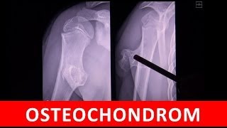 Osteochondrom  MRT CT und Röntgen Darstellung  by Radiologie TV [upl. by Oijimer]