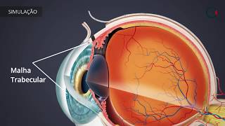 Tratamentos para o Glaucoma TRABECULECTOMIA [upl. by Gilbart]