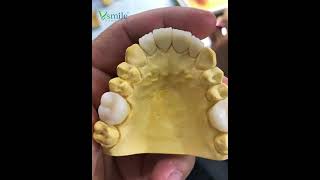 Zirconia crown with Vsmile ST multilayer 🤩 [upl. by Rae]