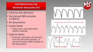 VT Ventricular Tachycardia vs SVT Supraventricular tachycardia with aberrancy [upl. by Nortal]