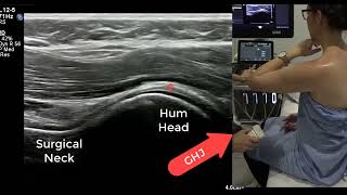 Ultrasound Shoulder  tips for successful rotator cuff and inferior glenohumeral ligament imaging [upl. by Yruy]