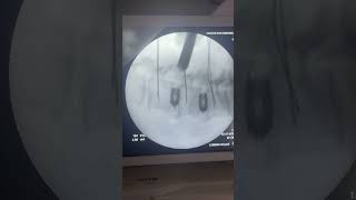 IMG 3041  Dr Abbasi Uses Inspired Spine Facet Decorticator In The OR  X  Ray View [upl. by Elvin846]