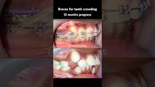 Crooked teeth Braces in 12 months progress braces orthodontics dental dentist teethbits [upl. by Neehs]