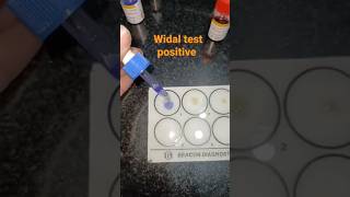 Serological practical WIDAL test typhoidfever trending practical pathology shorts [upl. by Carbo]