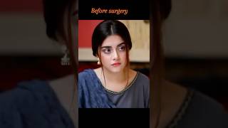 Alizey Shah Before after surgery 😱😳alizeyshah pakistanidramaactorsactressshortsfeedshortvideo [upl. by Aihtniroc]