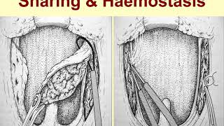 4 Tonsillectomy amp adenoidectomy  for MBBS PG students [upl. by Careaga]