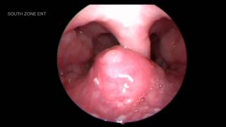 OTORHINOLARYNGOLOGY SERIES DISCUSSION TIME  LINGUAL TONSIL [upl. by Melly164]