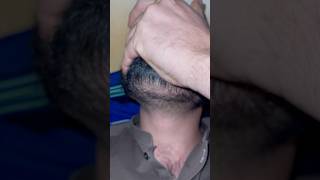 Asmr beard 🧔 barbershop haircare barber ingrownhairs ingrownhairremoval hairissue removing [upl. by Mile333]