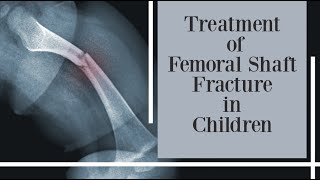 treatment of femoral shaft fracture in children [upl. by Hahnke584]