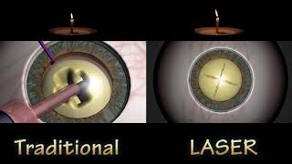 FLACS VS TRADITIONAL CATARACT SURGERY  Nucleus Removal Compare [upl. by Boelter759]