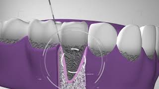 Curetaje higiene dental Te explicamos el procedimiento en Dentix [upl. by Ahsiakal]