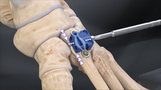 2nd TMT Arthrodesis With DynaNite® Compression Plate and KreuLock™ Screws [upl. by Leaffar]