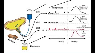 URODYNAMIC STUDY IN CHILDRENBASICS TO ADVANCED [upl. by Aihsi]