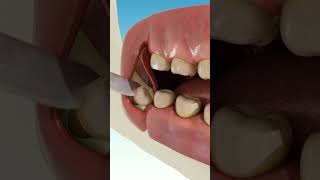 Wisdom tooth removing [upl. by Anes]