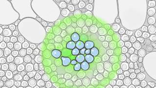 Radium223 and Metastatic Prostate Cancer [upl. by Atrahc793]