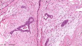 Fibroadenoma  Histopathology [upl. by Labinnah]