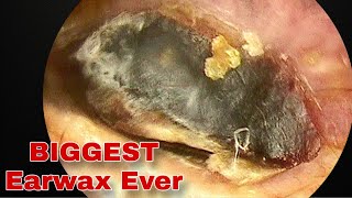 Removes BIGGEST Earwax on both sides EP7  Doctor Anh [upl. by Webber9]